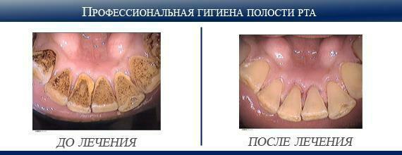 Профессиональная гигиена полости рта Гигиена полости рта